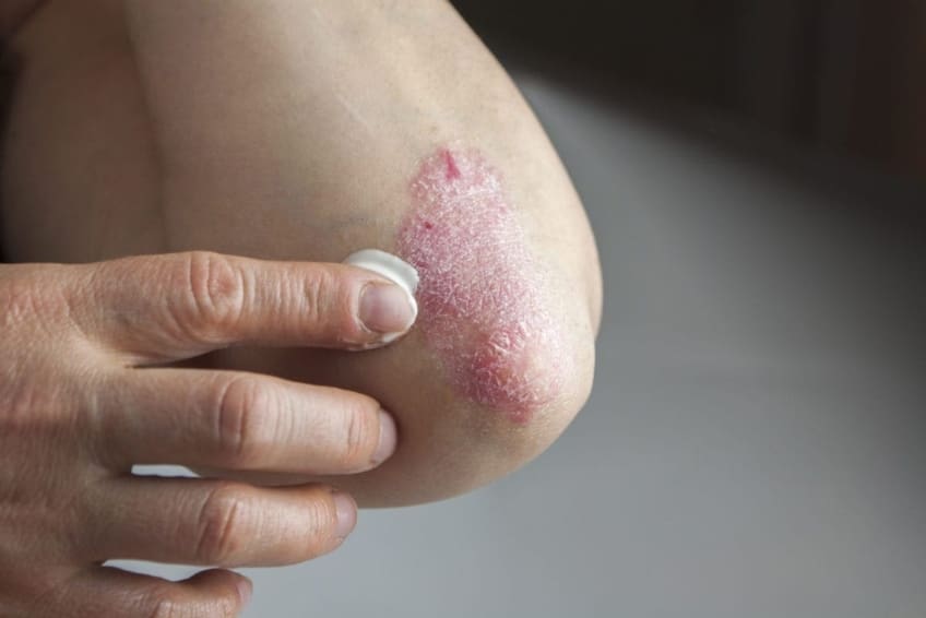 Mujer aplicándose loción para la psoriasis en el codo