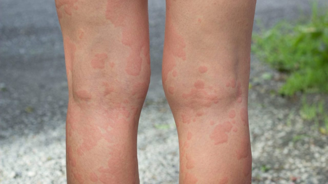 Piernas hinchadas con manchas rojas
