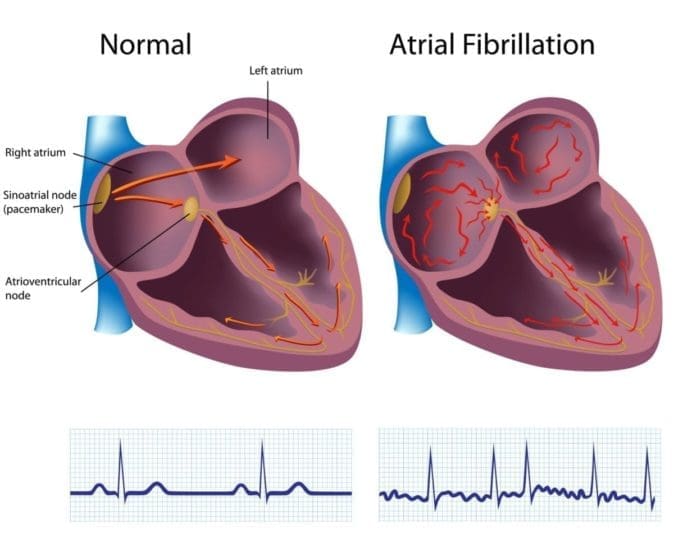 Ilustración de un corazón que es normal y sus latidos, en comparación con uno con fibrilación auricular