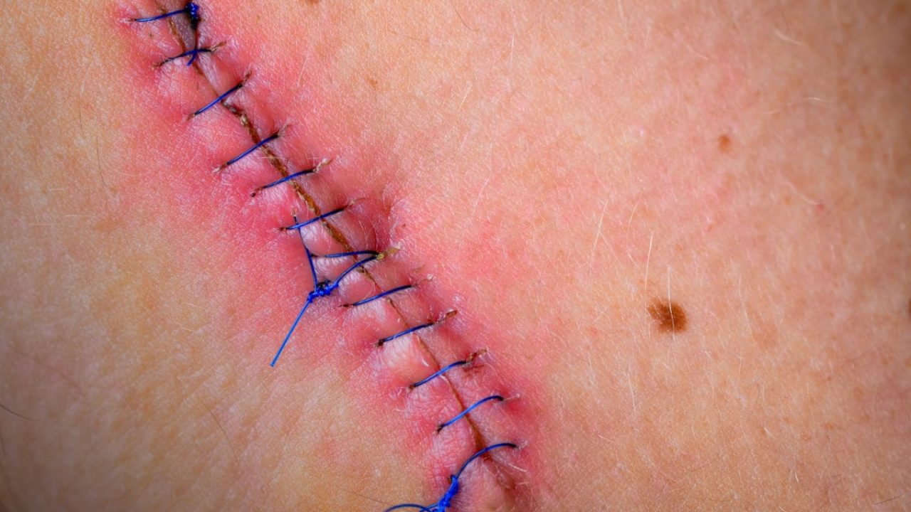 Cuanto dura una cirugia de histerectomia Cuanto dura una cirugia de histerectomia