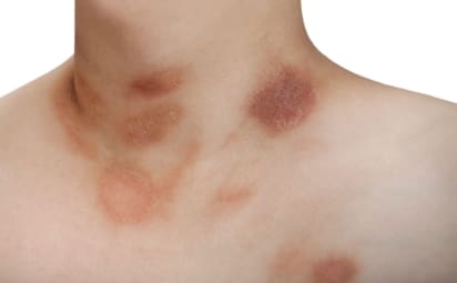 psoriasis pustulosa leve