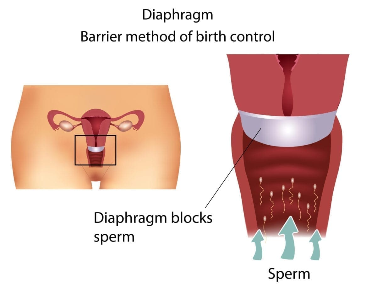 Resultado de imagen para diafragma preservativo