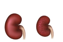 Imagen que muestra un riñón normal y otro con nefropatía diabética