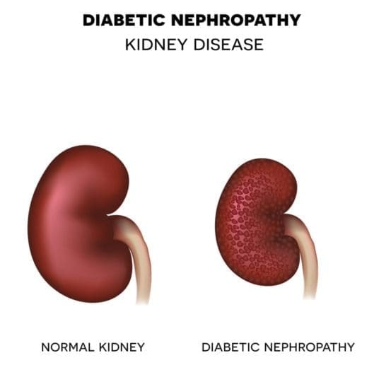 Imagen que muestra un riñón normal y otro con nefropatía diabética