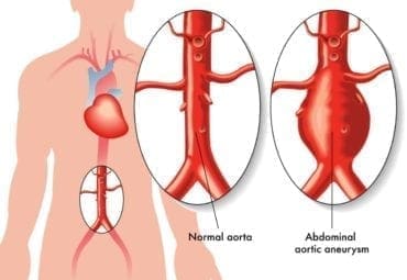 epicondilitis causas sintomas y prevencion