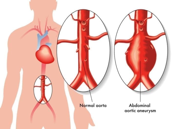 Ilustración de un cuerpo humano con primeros planos de una aorta normal y una de un aneurisma aórtico abdominal
