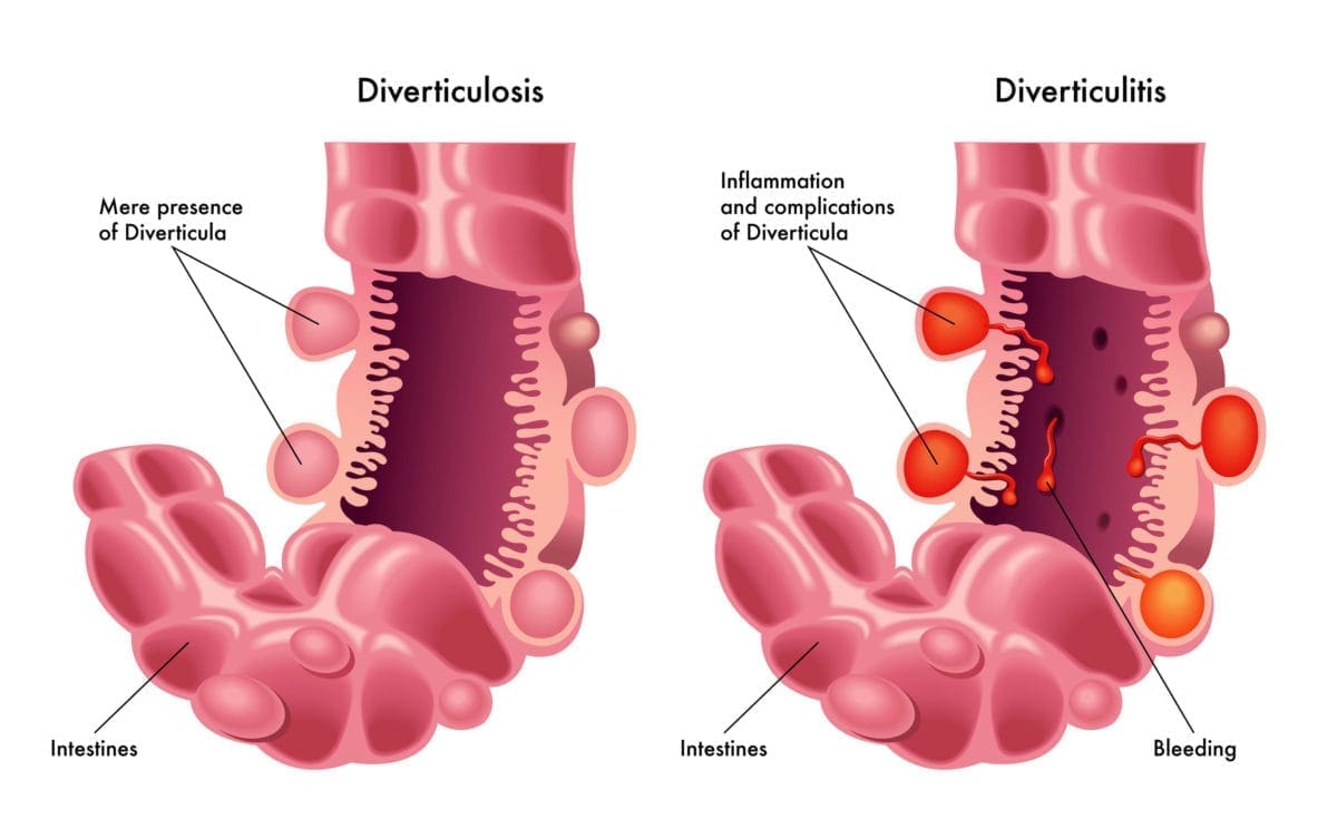 ¿Puede la diverticulitis embellecer sin antibióticos?