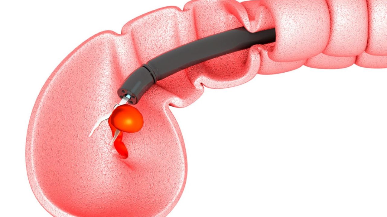 Porque salen los polipos en el cuello del utero